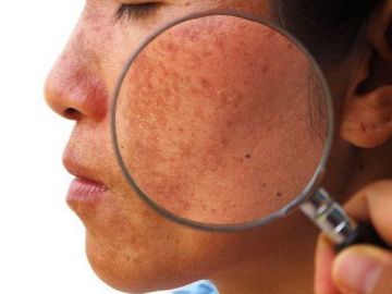 Bệnh nám da mùa hè, phòng và điều trị hiệu quả ai cũng nên biết