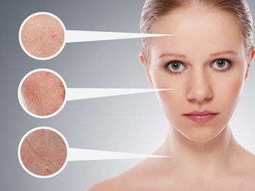 Điều trị lỗ chân lông to trên mặt thế nào?