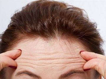 Lý do trán của bạn xuất hiện nhiều nếp nhăn