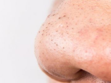 Nặn mụn đầu đen ở mũi thế nào cho đỡ hại da?
