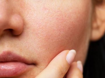 Cách làm giãn lỗ chân lông ở mặt