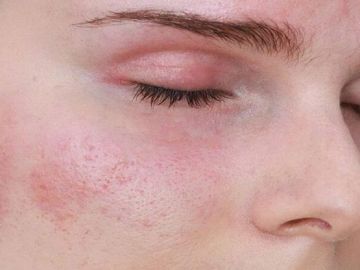Nám da do dùng retinol chống lão hóa, xử trí thế nào?