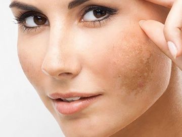 Sử dụng retinol bị sạm da là do đâu?