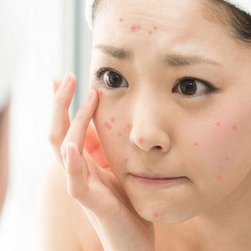 Làm thế nào để da không nổi mụn trong mùa hè?