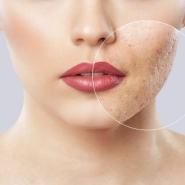 6 vấn đề da hay gặp vào mùa đông, bạn cần chú ý để chăm sóc da tốt nhất