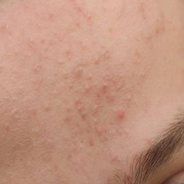 Áp dụng cách này hết mụn ẩn chỉ trong 7 ngày