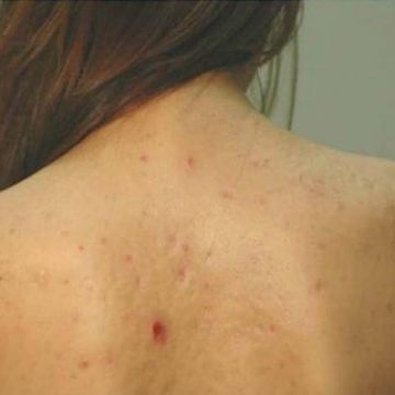 Cách khắc phục tình trạng mụn ở lưng đơn giản nhất