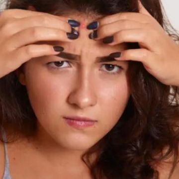 5 lý do khiến mụn trên trán nổi nhiều