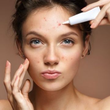 5 thói quen khiến điều trị mụn mãi không khỏi