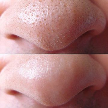 Công thức trị mụn đầu đen chỉ với mật ong và chanh