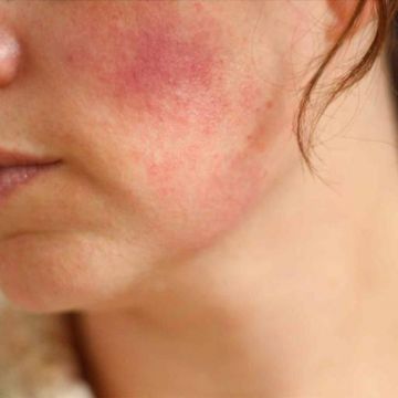 Cách cai và phục hồi da nhiễm corticoid do kem trộn