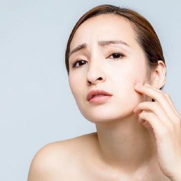Cách điều trị mụn trứng cá tuổi dậy thì