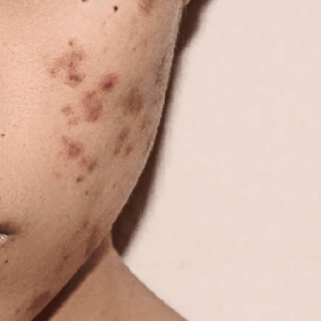 Mụn thâm nguyên nhân do đâu? Làm thế nào để xử lý?