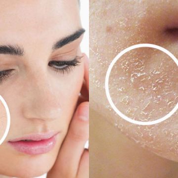 2 cách khắc phục tình trạng da khô ráp