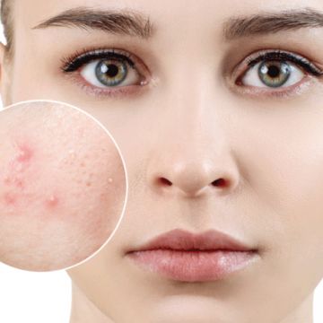Làm thế nào để da không nổi mụn trong mùa hè?