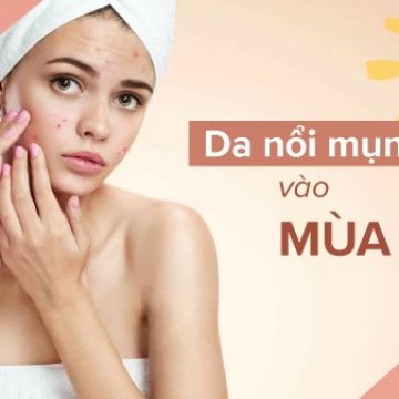 5 sai lầm khiến da nổi mụn vào mùa hè