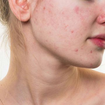 5 dấu hiệu cho thấy làn da đang bị kích ứng mỹ phẩm bạn cần lưu ý