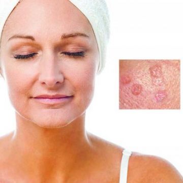 Da tăng sản: Nguyên nhân, chẩn đoán và điều trị