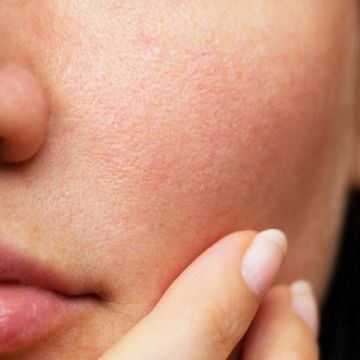 Cách làm giãn lỗ chân lông ở mặt