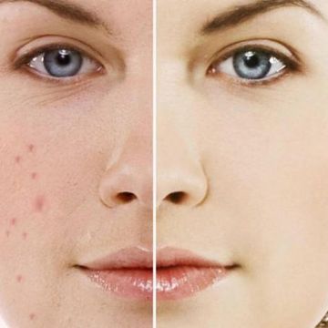 Điều trị tăng sắc tố da: Axit, Peel, Laser và hơn thế nữa
