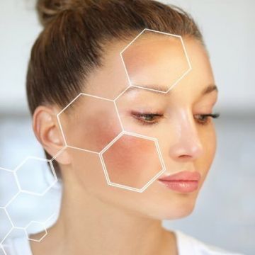 Điều trị nám bằng laser có hiệu quả không?