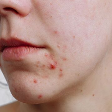 Nặn trứng cá thế nào để sớm hết mụn?