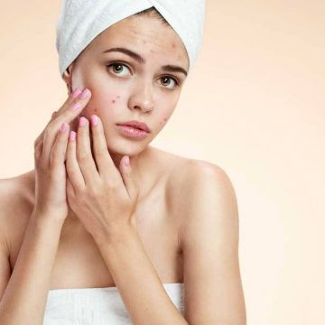 Hạn chế tình trạng nổi mụn ngày nóng