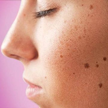 Phòng tránh đồi mồi trên da khi thời tiết nắng nóng