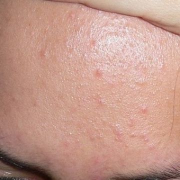 Nguyên tắc điều trị mụn ẩn bạn cần nhớ