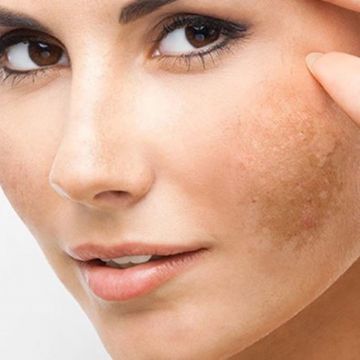2 cách đơn giản giúp bạn phòng ngừa sạm da tại nhà