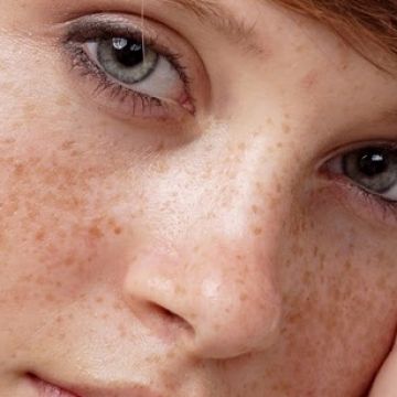 3 cách giúp bạn thoát khỏi tình trạng tàn nhang