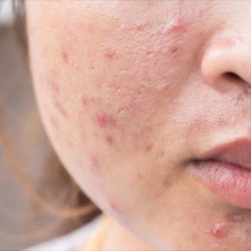 Những thói quen xấu cần từ bỏ khi bị mụn