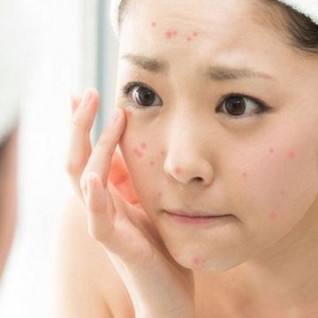 2 công thức trị mụn trứng cá cho da khô
