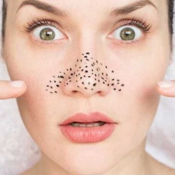 Các loại mụn trứng cá và một số tips đơn giản để giải quyết bằng nguyên liệu tự nhiên