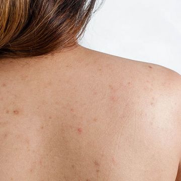 Trị thâm mụn vùng lưng hiệu quả bằng cách đơn giản